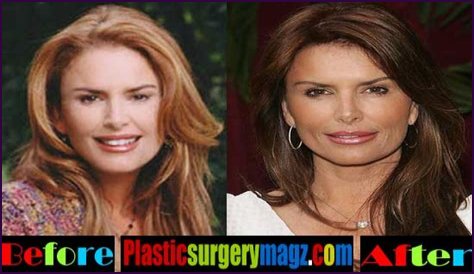 Roma Downey Plastic Surgery Before and After
